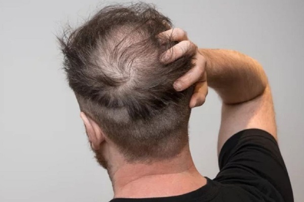 Đi khám vì tóc rụng, người đàn ông bất ngờ phát hiện mắc giang mai-1