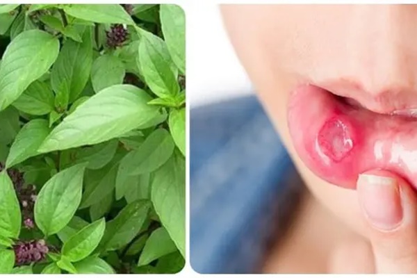 Bị nhiệt miệng nên ăn gì để nhanh khỏi?-1