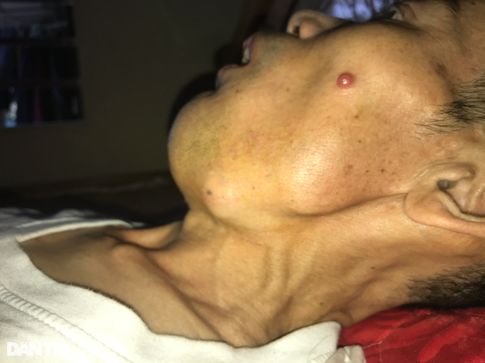 Con trai bị ung thư giấu giấy hẹn nhập viện mong nhường lại sự sống cho bố-3