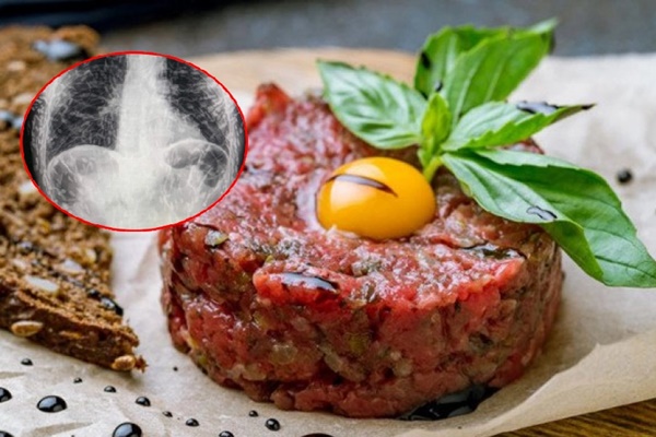 Lâm Đồng: Nhầm kết quả X-quang, bệnh nhân phải thực hiện nội soi tìm dị vật-3