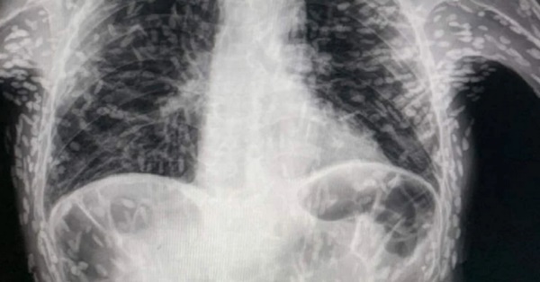 Đi chụp X-quang, người đàn ông tá hỏa vì người toàn ký sinh trùng: Cảnh báo những món chứa nhiều giun sán-1