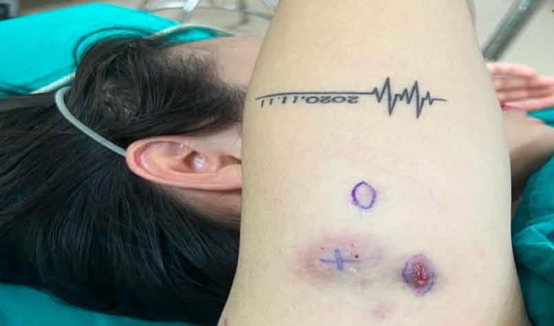 Nổi u cục khắp người sau khi tiêm tan mỡ giảm béo ở spa người quen-1