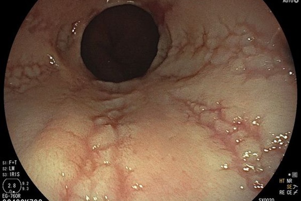 Thực quản của người đàn ông trắng như da heo, sần sùi và lở loét vì sở thích ăn uống không hiếm gặp-1