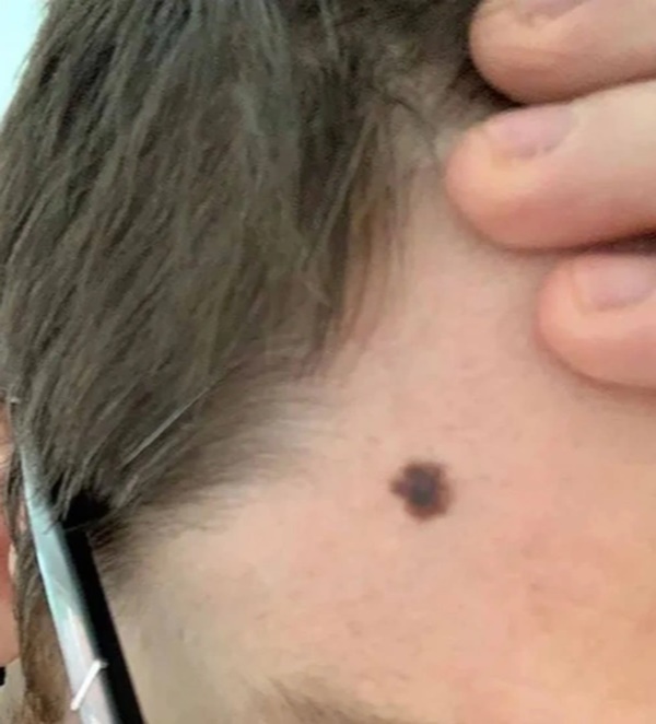 5 dấu hiệu khó nhận biết của ung thư da và lời kêu gọi của chuyên gia da liễu-1