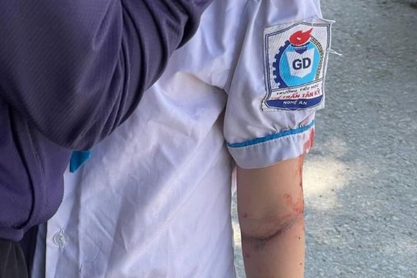 Bé gái 8 tuổi bị gãy tay do áo chống nắng cuốn vào bánh xe-1