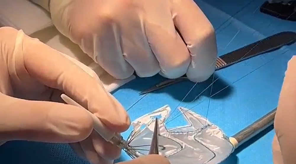 Vinmec áp dụng công nghệ 3D hỗ trợ can thiệp tim mạch-2