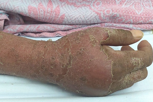 Hình ảnh bàn tay gây ám ảnh của bệnh nhân dị ứng thuốc kháng lao-1