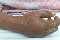 Hình ảnh bàn tay gây ám ảnh của bệnh nhân dị ứng thuốc kháng lao