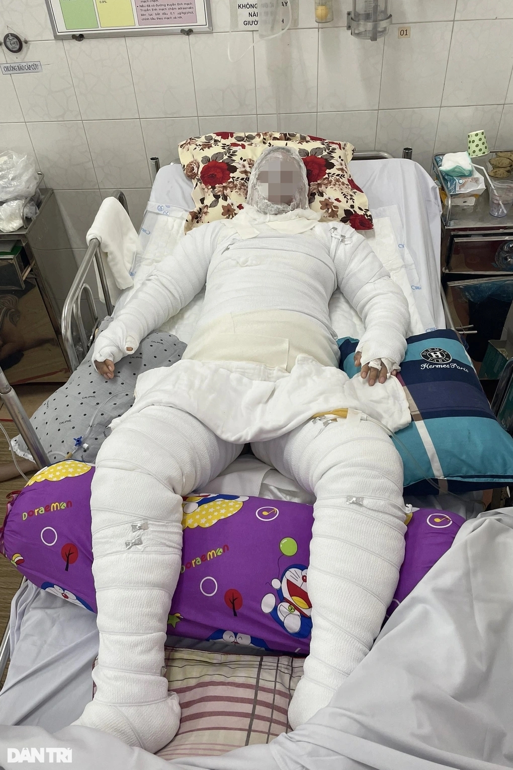 Nướng mực đãi tiệc cho thai phụ sắp sinh, 3 người trong nhà bỏng thương tâm-2