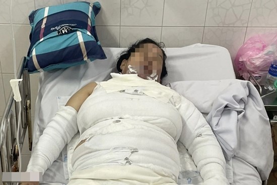 Nướng mực đãi tiệc cho thai phụ sắp sinh, 3 người trong nhà bỏng thương tâm