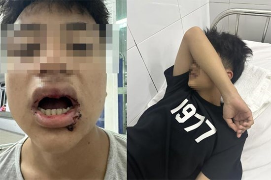 Nam sinh ở Đà Nẵng bị nhóm thanh niên đánh gãy 4 răng, nhấn xuống biển
