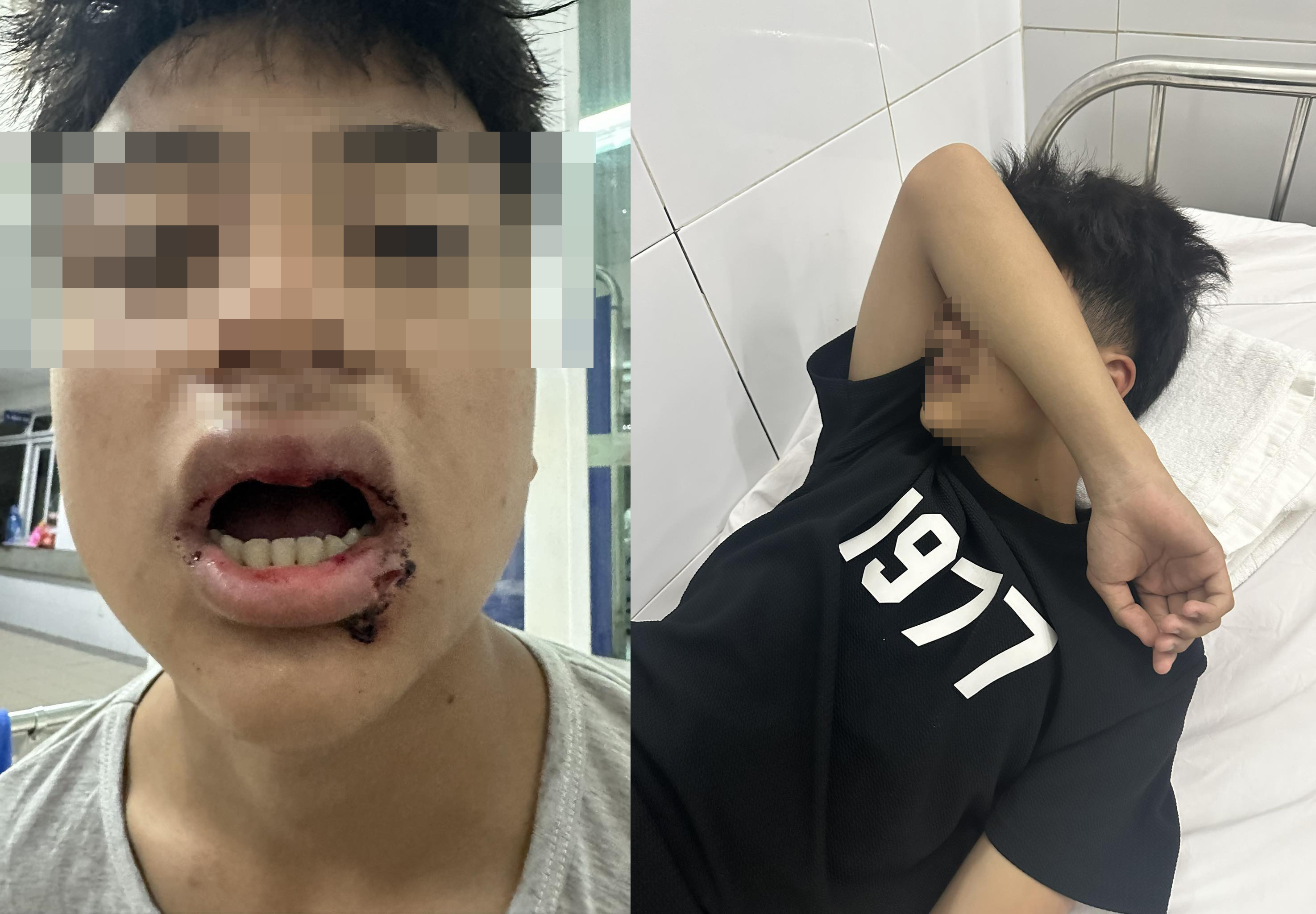 Nam sinh ở Đà Nẵng bị nhóm thanh niên đánh gãy 4 răng, nhấn xuống biển-2