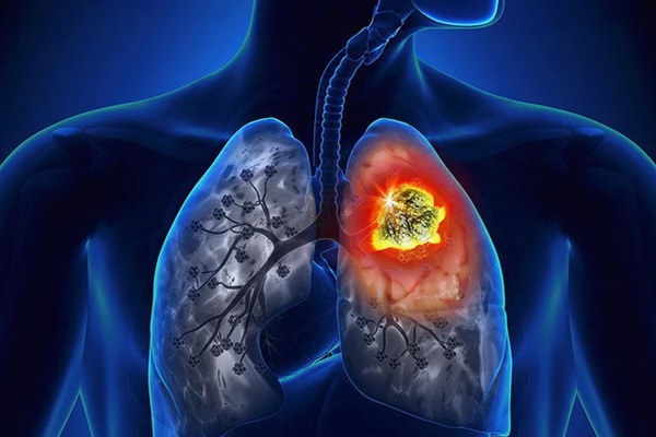 Ung thư phổi đang rình rập” bạn nếu thức dậy buổi sáng thấy có dấu hiệu này-1