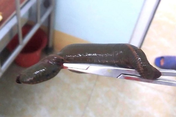 Con đỉa to bằng ngón tay bám chặt cổ họng người đàn ông-2