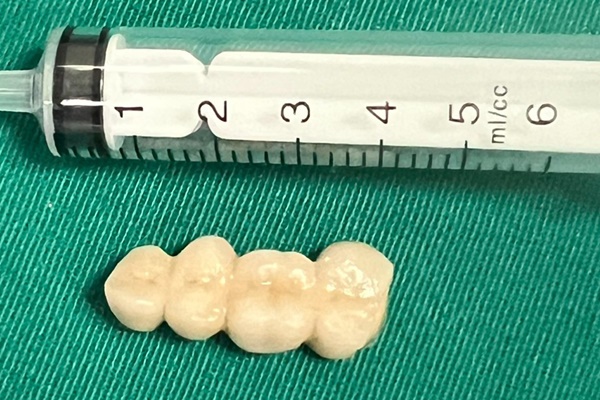 Tình huống hi hữu khiến 4 chiếc răng giả dính liền tuột vào dạ dày-1