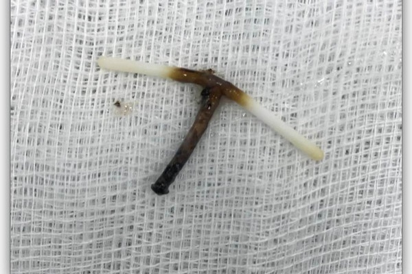 Cô dâu ở Hưng Yên nhập viện vì gài kim vào sau váy cưới-2