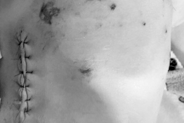 Bé trai 3 tuổi bị chó béc giê cắn thủng bụng-1