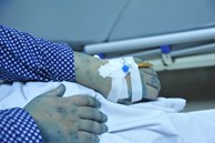32 tuổi tử vong do mắc thuỷ đậu: Bác sĩ BV Bạch Mai khuyến cáo điều thường bỏ qua
