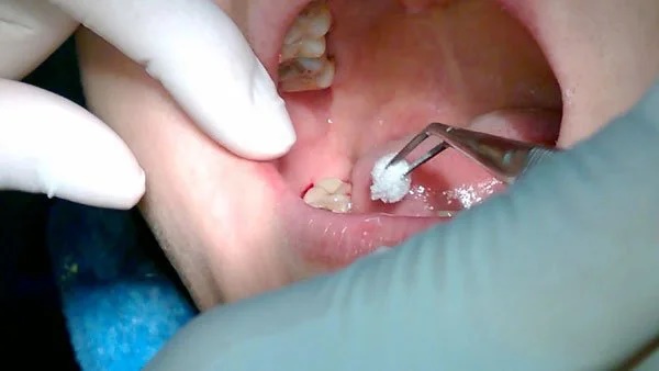 Cô gái 23 tuổi tử vong sau nhổ răng khôn: Bác sĩ chỉ ra những lưu ý tránh biến chứng nguy hiểm-4