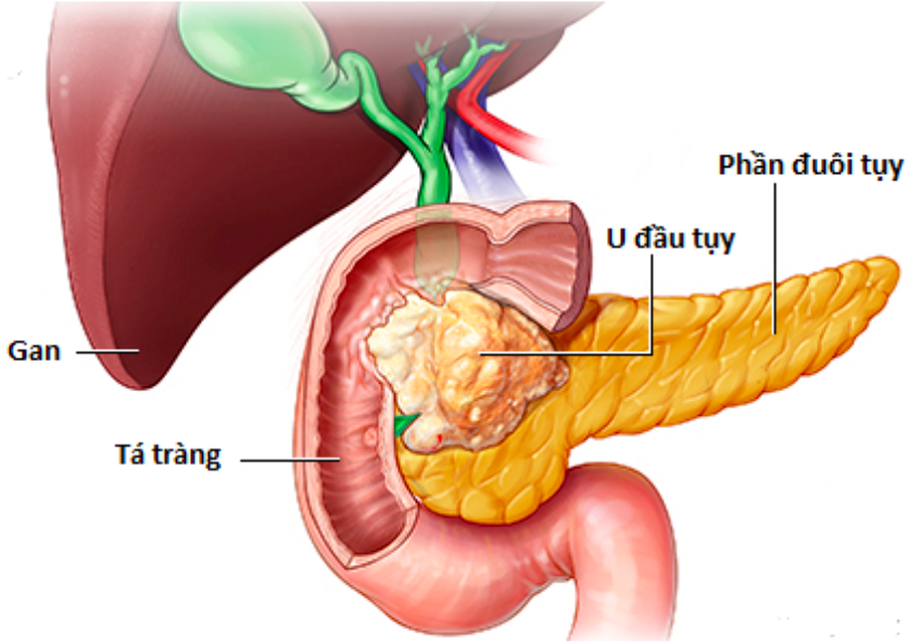 Căn bệnh ung thư gây tử vong nhanh, dấu hiệu cần lưu ý-2