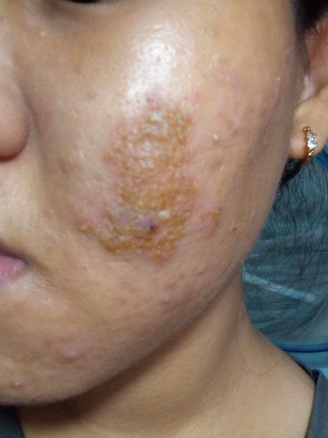 3 biến chứng đáng sợ khi nặn mụn không đúng cách-1