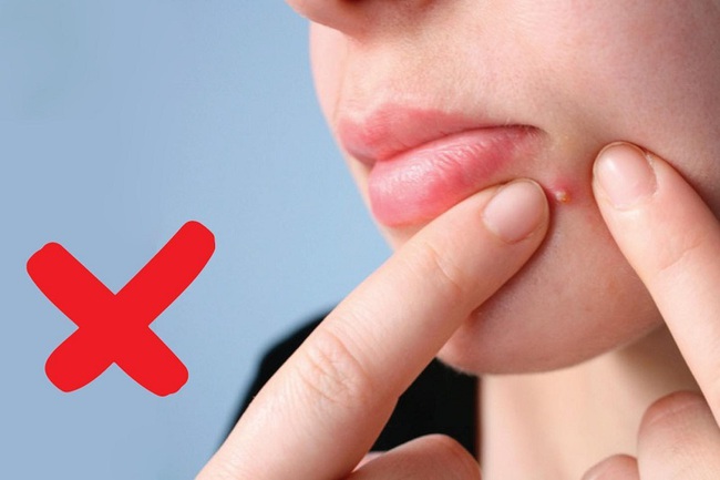 3 biến chứng đáng sợ khi nặn mụn không đúng cách-2