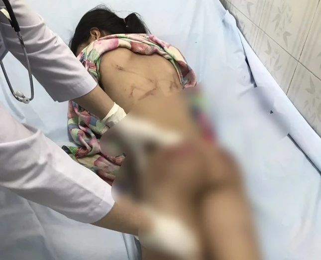 Điều tra vụ bé gái bị chi chít vết thương khi ở với cô họ-1
