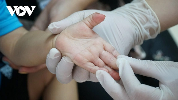 Một bệnh nhi ở Đắk Lắk tử vong vì tay chân miệng-1