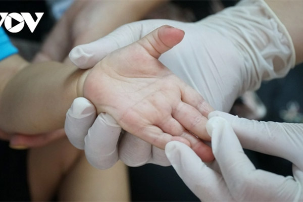 Trẻ 1 tuổi tử vong vì tay chân miệng, cha mẹ cần nhớ các dấu hiệu nguy hiểm-2