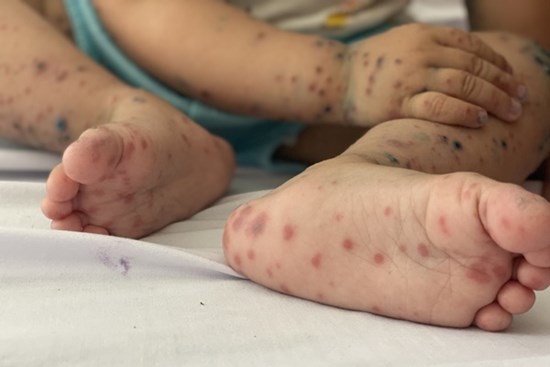 Trẻ 1 tuổi tử vong vì tay chân miệng, cha mẹ cần nhớ các dấu hiệu nguy hiểm