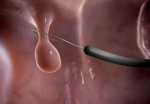 Khi ung thư ruột xuất hiện cơ thể sẽ có 3 nhiều, 2 đau, nên ăn nhiều 2 loại rau để bảo vệ đường ruột-3