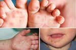 TP. Hồ Chí Minh: Enterovirus 71 gây bệnh tay chân miệng nặng ở trẻ em đã xuất hiện trở lại-2