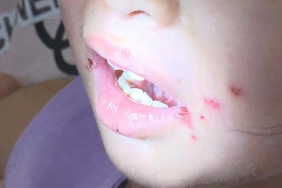 TP. Hồ Chí Minh: Enterovirus 71 gây bệnh tay chân miệng nặng ở trẻ em đã xuất hiện trở lại