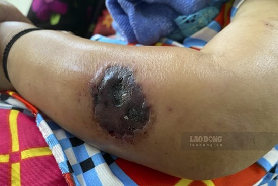 Điện Biên ghi nhận ca bệnh than thứ 14 không rõ nguồn lây