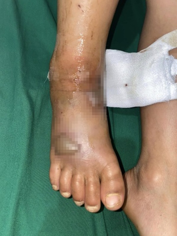 Đi bộ trong xóm, bé trai 8 tuổi bị rắn độc cắn-2