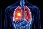 Phát hiện ung thư phổi di căn từ triệu chứng đau lưng-2