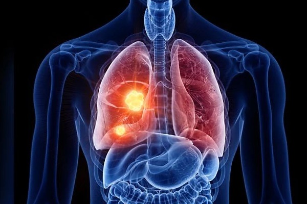 Nghiên cứu ra thuốc chữa ung thư phổi giảm nguy cơ tử vong 51%-1