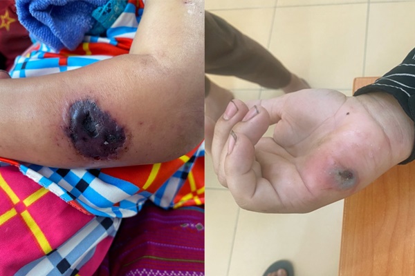 Vi khuẩn bệnh than có thể tồn tại ngoài môi trường từ 30-40 năm-1