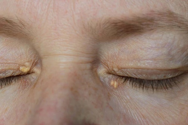 7 người ở Thanh Hóa bị ngộ độc nghi do uống rượu ngâm nấm-1