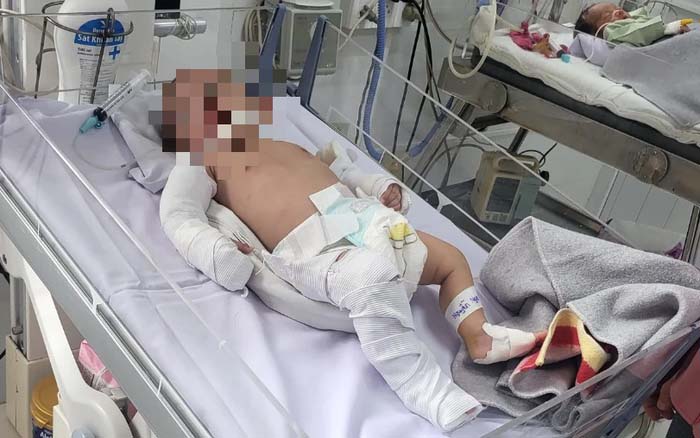 Bé gái 2 tháng tuổi bị bạo hành dã man đã được xuất viện-1