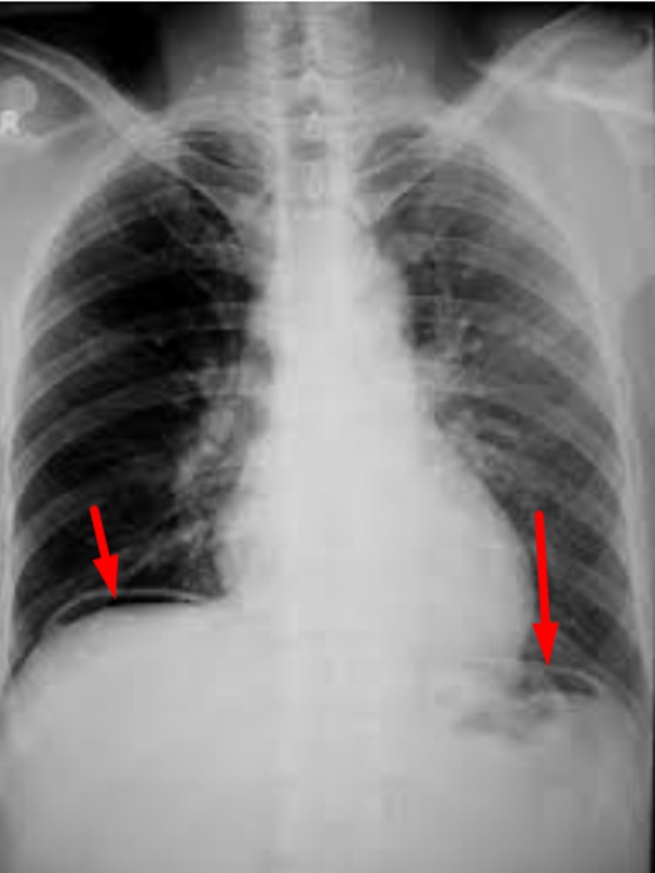 15 tuổi thủng dạ dày: Bác sĩ điểm danh thủ phạm, chỉ cách phòng ngừa-1