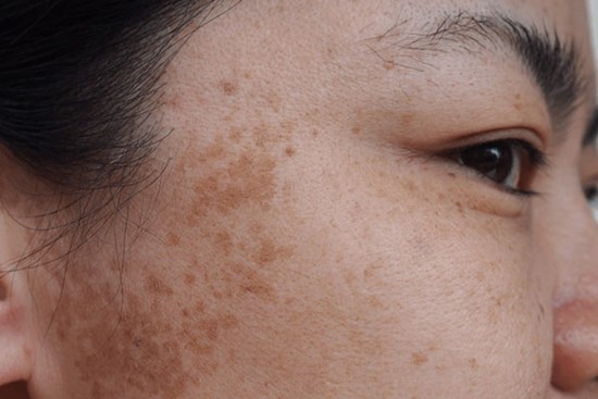 Thành phần tẩy da chết dành cho làn da bị nám