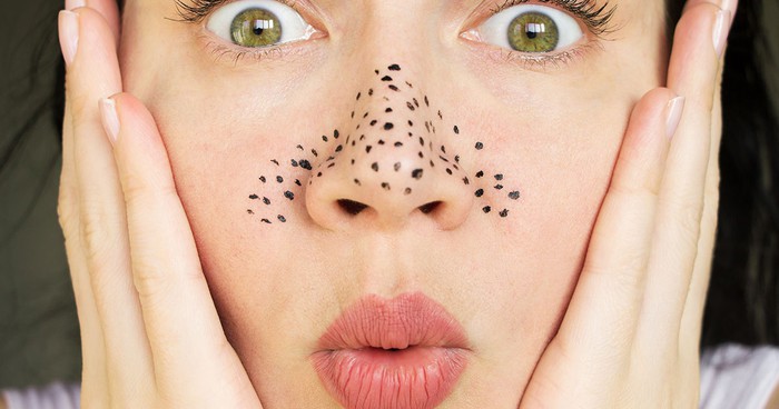 Sợi bã nhờn gia tăng vào mùa hè, làm thế nào để loại bỏ?-1