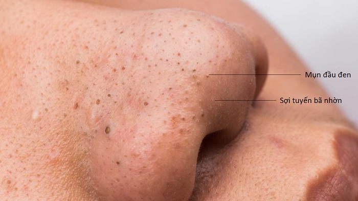 Sợi bã nhờn gia tăng vào mùa hè, làm thế nào để loại bỏ?-2