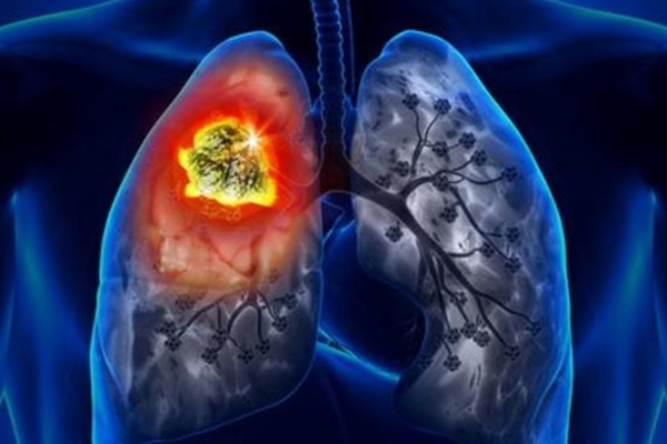 Phát hiện ung thư phổi di căn từ triệu chứng đau lưng-1