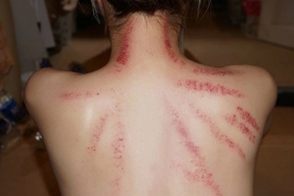 Cạo gió cần tránh 4 vùng cấm kỵ, ai cũng nên biết để không gặp nguy hiểm-2