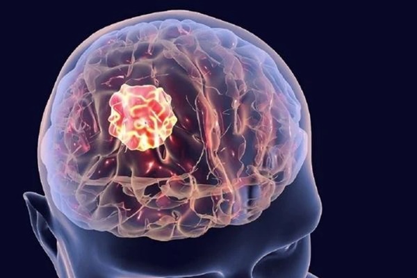 Từ đau đầu đến ung thư di căn não: Cần biết về triệu chứng và phương pháp điều trị-1