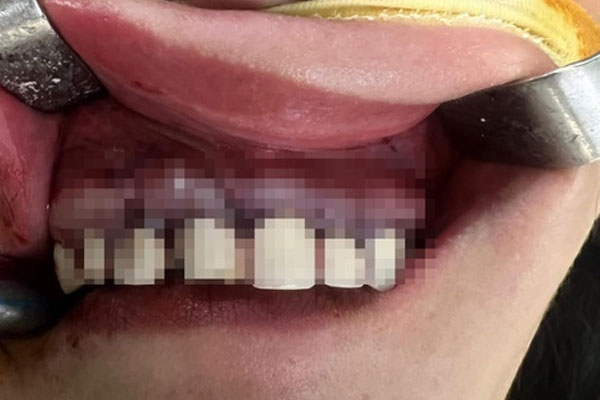 Người phụ nữ 36 tuổi phải phẫu thuật do bọc răng thẩm mỹ-1