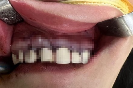 Người phụ nữ 36 tuổi phải phẫu thuật do bọc răng thẩm mỹ