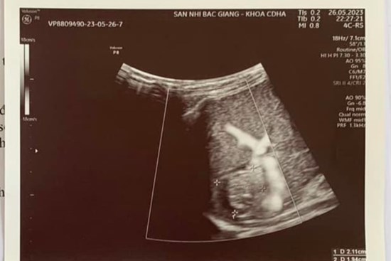 Đang chơi cùng bạn, bé trai ngã vỡ đôi lá lách